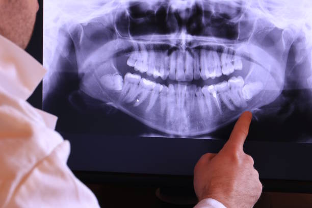 Best Emergency Root Canal Treatment in Johnson City, NY